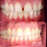 Dental Veneers