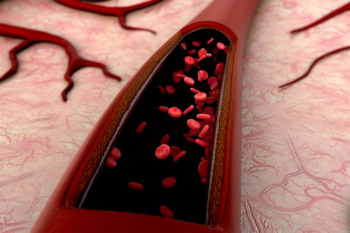 Hyperbaric oxygen therapy improving blood circulation by delivering increased oxygen to tissues affected by hypoxia and hypoxemia.