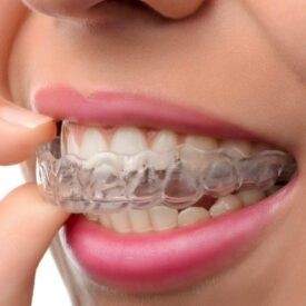 Patient undergoing Invisalign treatment at Dental Point dental clinic Kochi